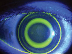 The anterior segment after fluorescein