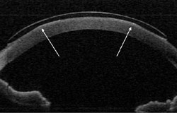 Anterior segment optical coherence