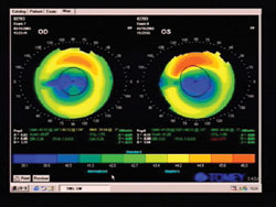 Corneal topography after successful