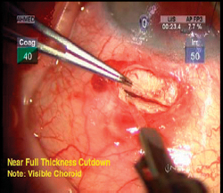 A 95% thickness scleral cut-down is created after a conjunctival