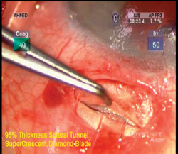 A scleral tunnel incision is created forward to fashion the pocket in