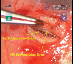 A full thickness incision has been made, and choroid is visible at the