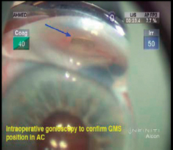 Gonioscopy is a helpful adjunct during surgery to assess the position of