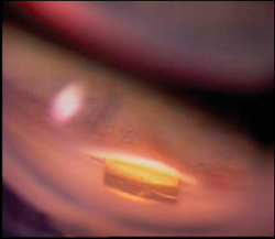 A postoperative photograph using a gonioscopy lens to view the shunt.