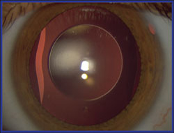 Eyes of pediatric patients have been implanted with the Visian ICL. 