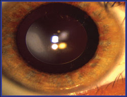 Eyes of pediatric patients have been implanted with the Visian ICL. 