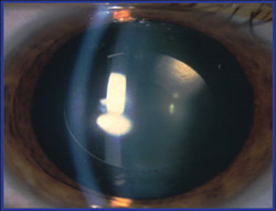 Eyes of pediatric patients have been implanted with the Visian ICL. 