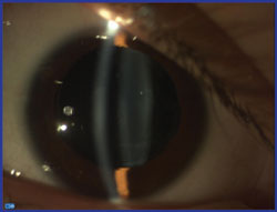 Eyes of pediatric patients have been implanted with the Visian ICL.