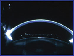 Ultrasonographic biomicroscopy and WaveLight Allegretto images of eyes