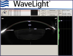 Ultrasonographic biomicroscopy and WaveLight Allegretto images of eyes