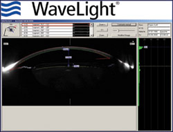 Ultrasonographic biomicroscopy and WaveLight Allegretto images of eyes