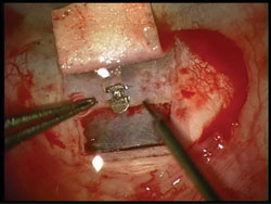 Optonol Ex-PRESS P50 mini glaucoma shunt.