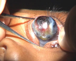 Figure 1: A 4-month-old infant with anterior staphyloma.