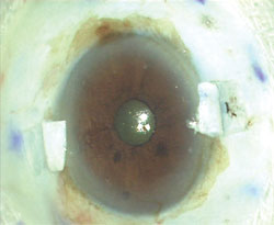 Figure 2a: Scleral flaps are created on the donor eye.