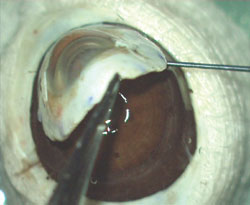 Figure 2b: Sclerocornea is taken from donor eye.