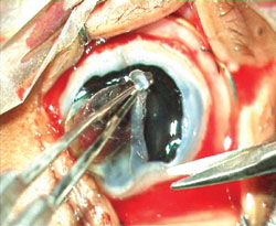 Figure 2e: Anterior staphylectomy is done.