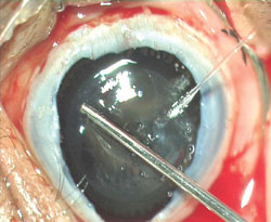 Figure 2f: Lensectomy is performed.