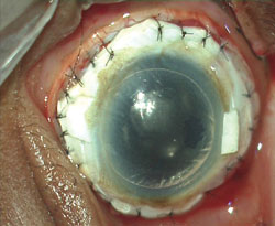 Figure 2g: Bioprosthetic graft is sutured onto recipient eye.