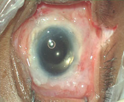 Figure 3: Postop at the end of surgery.