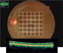 Fundus retinography of the left eye showing the rectangular map (6 mm x