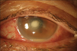 Infectious complications of contact lenses.