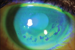 Infectious complications of contact lenses.