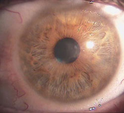 Herpes simplex keratitis with corneal ulceration, inflammation and