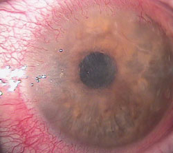 Herpes simplex keratitis with corneal ulceration, inflammation and