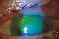 Persistent corneal epithelial defect due to acoustic neuroma healed by