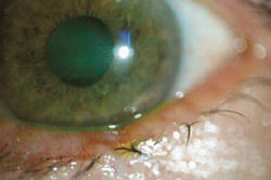 Persistent corneal epithelial defect due to acoustic neuroma healed by