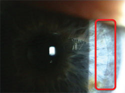 A clear corneal incision 1 day postop without