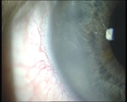 A clear corneal incision 1 day postop without