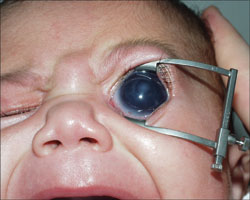 Congenital glaucoma in a Roma infant.