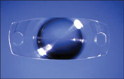 The Acqua (Mediphacos) expandable IOL is implanted in its dehydrated state and expands in the eye.