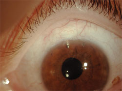 Figure 2. Example of a low diffuse bleb with the Ex-PRESS under scleral flap.