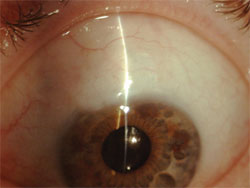 Figure 4. Example of a high conjunctival bleb with the Ex-PRESS under scleral flap.