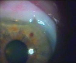 The stainless steel wire micro-drainage device in the anterior chamber - gonioscopic view.