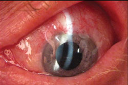 Outlook of the eyeball after 3 months following implantation of device with creation of fornix-based conjunctival flap.