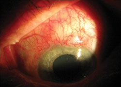 The eyeball after 6 months following simple procedure to implant device.