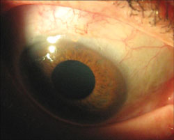 The eyeball after 1 year, which showed good results, with cataract surgery performed in only 7% of cases and one case requiring repeat surgery and insertion of another device.