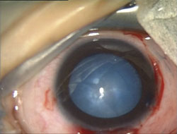 An intraoperative situs of a pediatric eye with cataract after staining with trypan blue. Staining was performed to improve visibility and reduce the elasticity of the capsule.