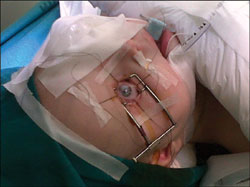 The eye is immobilized with four sutures in the conjunctiva.