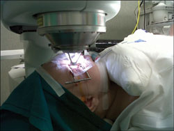 The IntraLase femtosecond laser creates the intrastromal channel 50 µm above the thinnest point of the cornea.