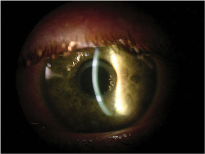 Figure 3: A slit-lamp view of the typical day 5 postoperative appearance. The bandage contact lens is still in situ and the thermal ring can clearly be seen centrally.