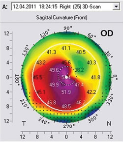 Figure 4: Pentacam preoperative baseline results. The preoperative Pentacam demonstrating central steepness of more than 75 D.