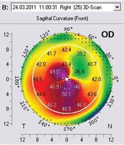 Figure 5: Pentacam 5 days postoperative results. Day 5 postoperative Pentacam demonstrating central keratometry readings in the low 50s - this represents central flattening of more than 20 D.