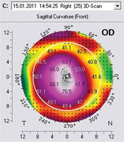 Figure 6: Pentacam 1-month postoperative results. Month 1 postoperative Pentacam  shows very minimal regression of the initial effect with the central keratomy readings still in the low 50s.