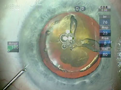 Image of the eye immediately prior to lens removal. Note the gas bubble posterior to the lens fragmentation pattern.