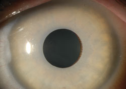 Image of the NewColorIris implant in the anterior chamber.