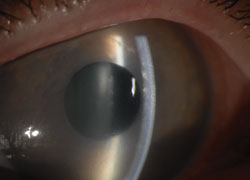 Slit beam image of the cornea demonstrating visually significant corneal edema resulting from the NewColorIris implant.